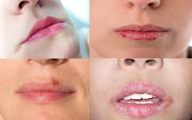 Giai đoạn chớm bị bệnh.