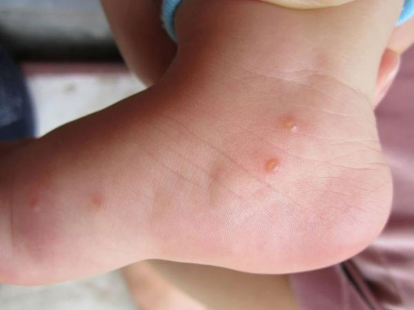 Mụn nước là một túi chất lỏng giữa các lớp biểu bì - lớp trên cùng của da