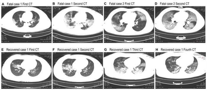 Hình ảnh CT ngực ở những bệnh nhân tử vong do nhiễm Covid-19