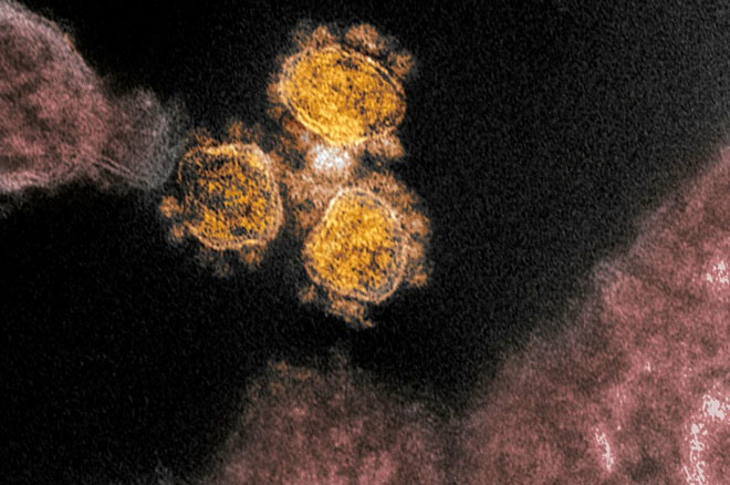 Hình ảnh virus SARS-CoV-2 thoát khỏi một tế bào dưới kính hiển vi điện tử