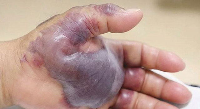 Bàn tay của một người đàn ông Hàn Quốc bị nhiễm vi khuẩn ăn thịt người sau khi ăn hải sản.