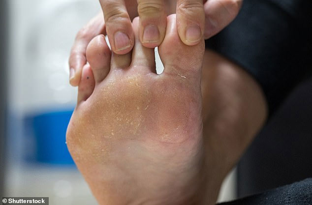 Rỗ da chân là một trong những nguyên nhân khiến chân luôn có mùi hôi