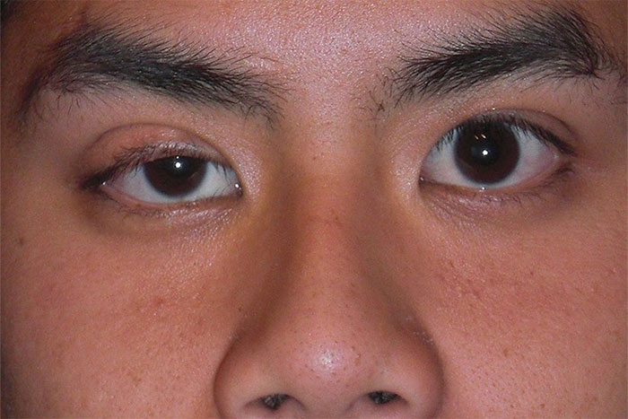 Sụp mí mắt là dấu hiệu đặc trưng của người mắc nhược cơ.