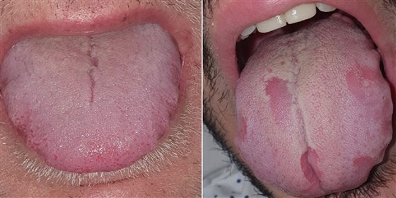 Các dấu hiệu của “lưỡi Covid”