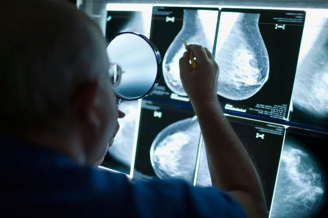 Tiêu diệt gene AAMDC sẽ tăng cường khả năng điều trị ung thư vú